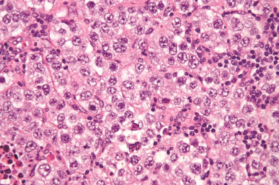 Genetics account for 50% of the risk of testicular germ cell tumours (micrograph pictured) in young men