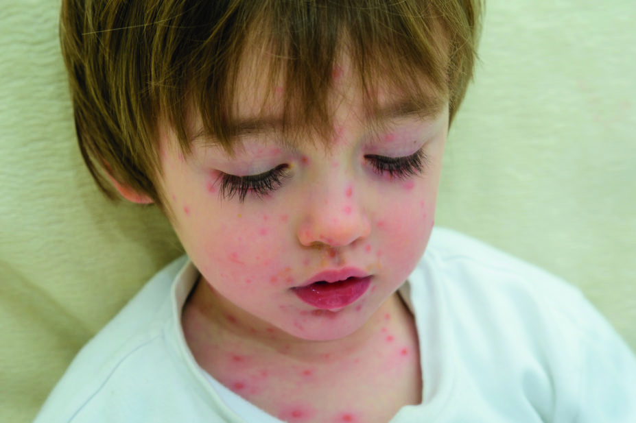 Toddler with chicken pox