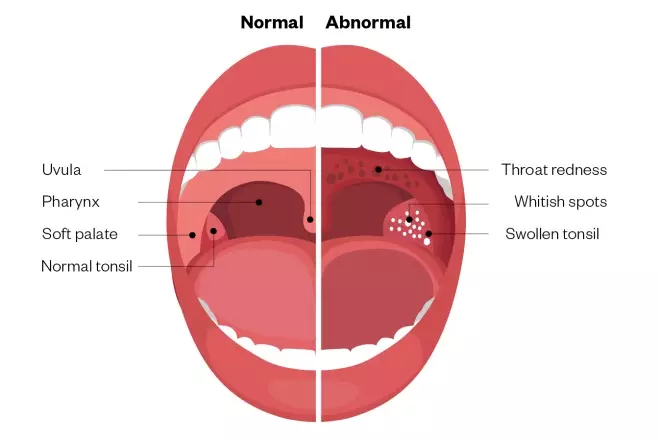 Hard Rough Throat