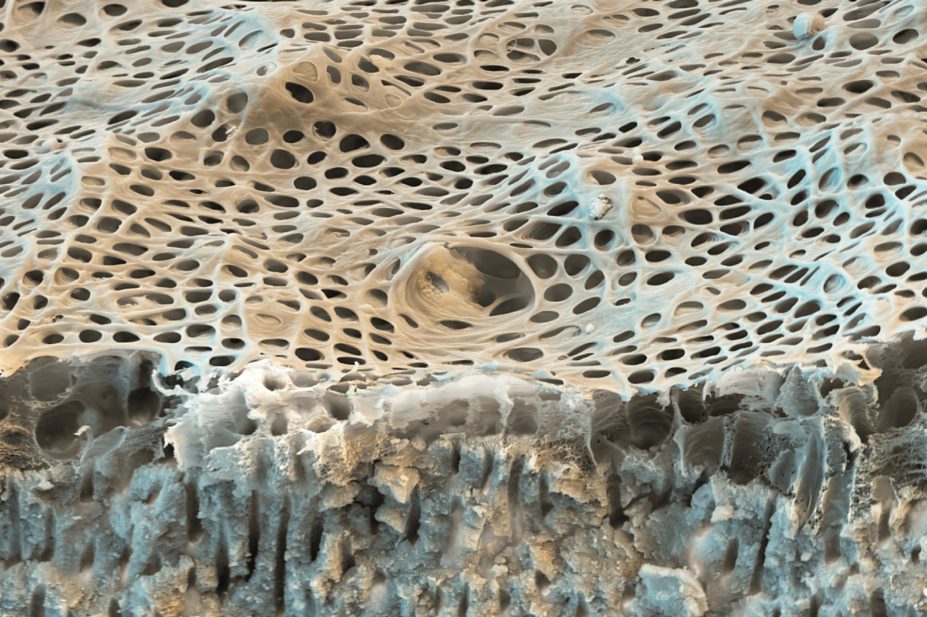 Micrograph of dentine tubules, which when exposed results in hypersensitivity
