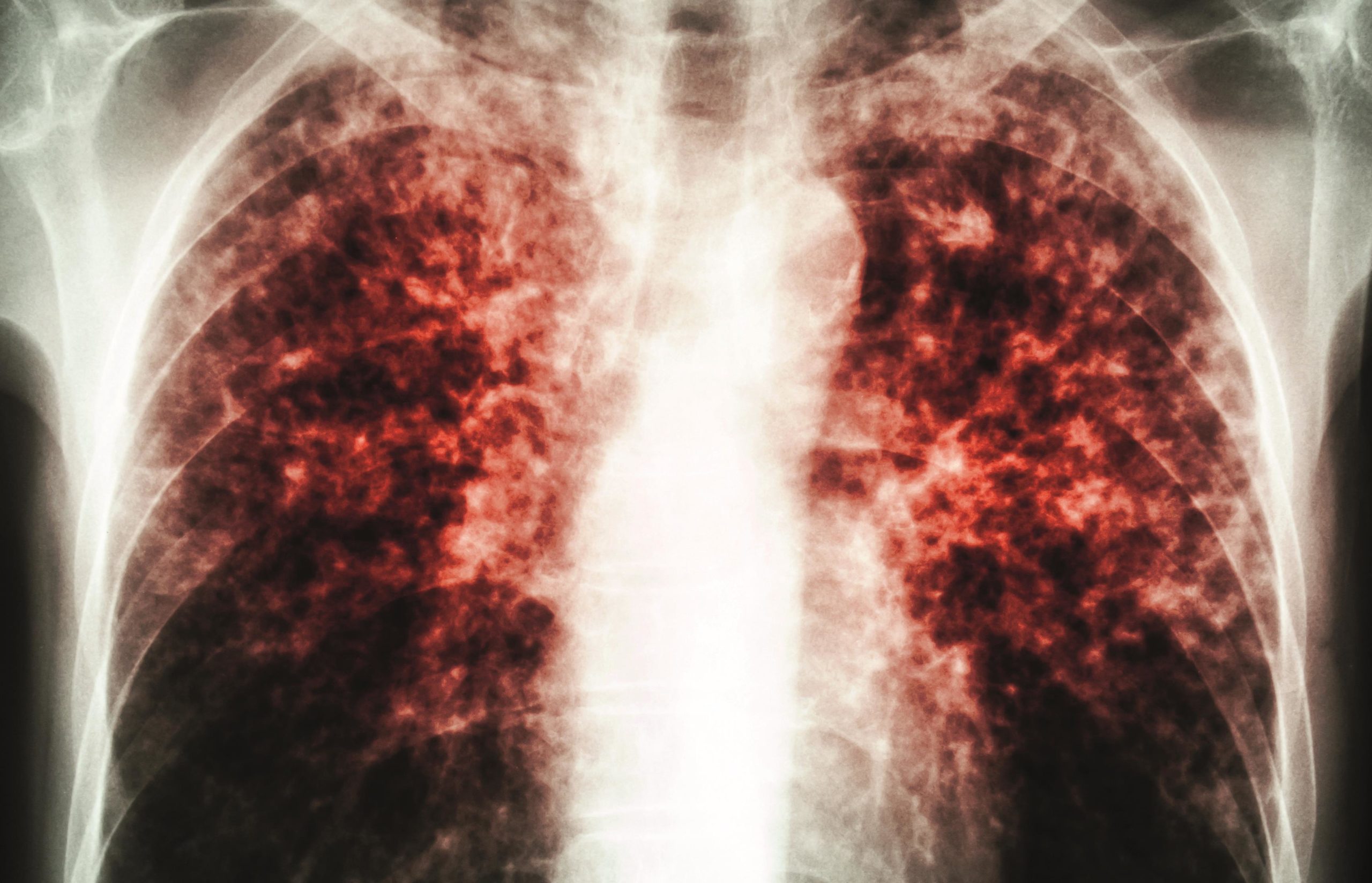 Туберкулез снимок рентген