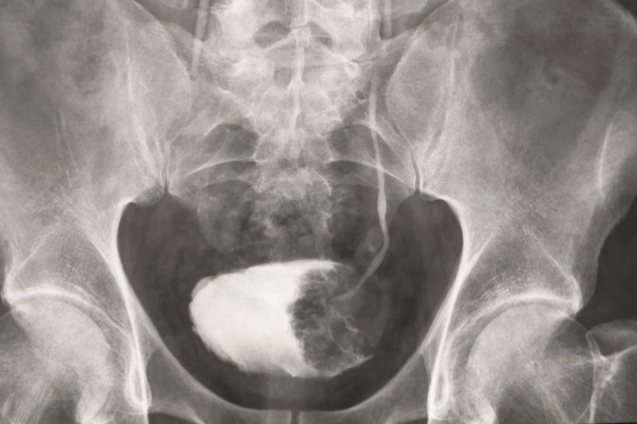 X-ray showing a tumour in urinary bladder