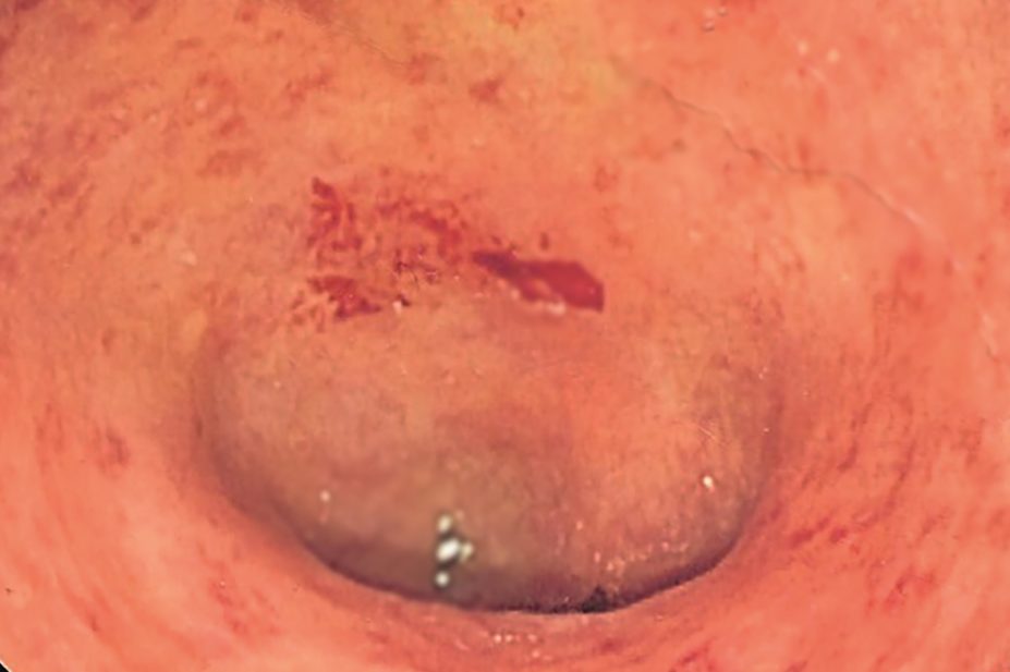 Endoscopic image of ulcerative colitis showing loss of vascular pattern of the sigmoid colon