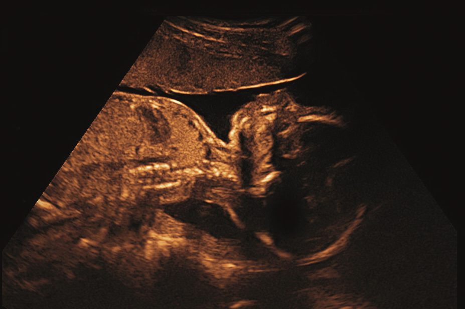 Pregnant women who take the commonly used analgesic paracetamol for more than a week could lead to reproductive problems in their male offspring, suggests a study. In the image, an ultrasound of a baby