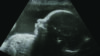 Ultrasound screen showing a baby