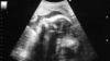 Ultrasound image of a fetus in the womb