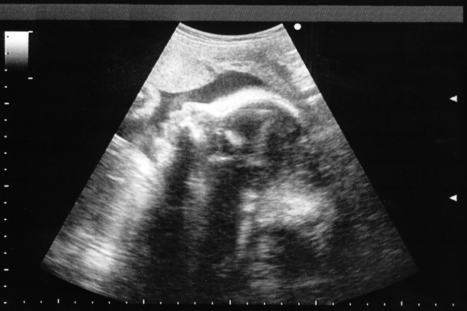 Ultrasound image of a fetus in the womb