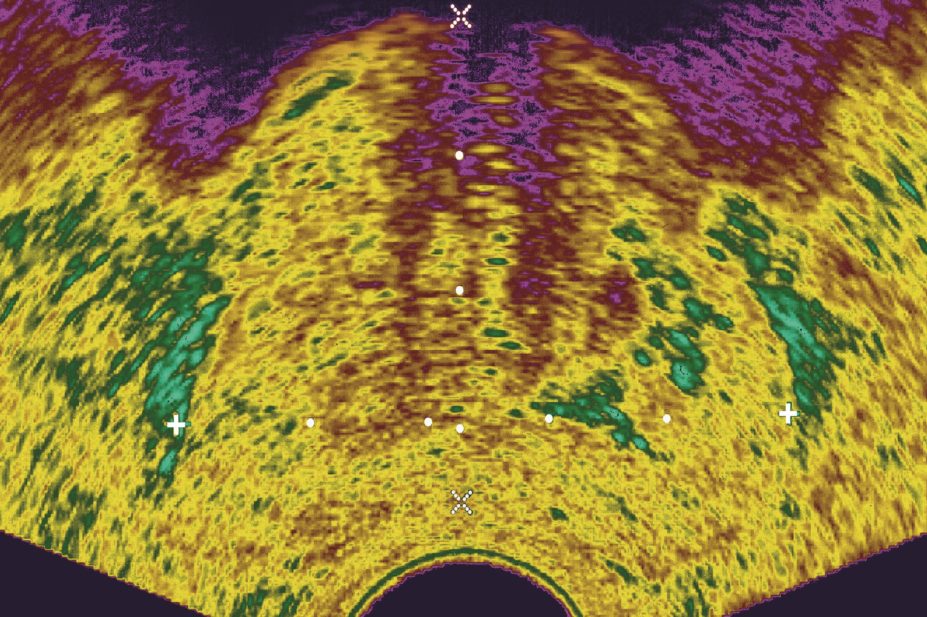 Androgen deprivation therapy (ADT) is a mainstay of prostate cancer treatment, but it could double the risk of Alzheimer’s disease in the long term, research finds. In the image, ultrasound showing prostate cancer