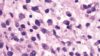 Plasmacytoid urothelial carcinoma