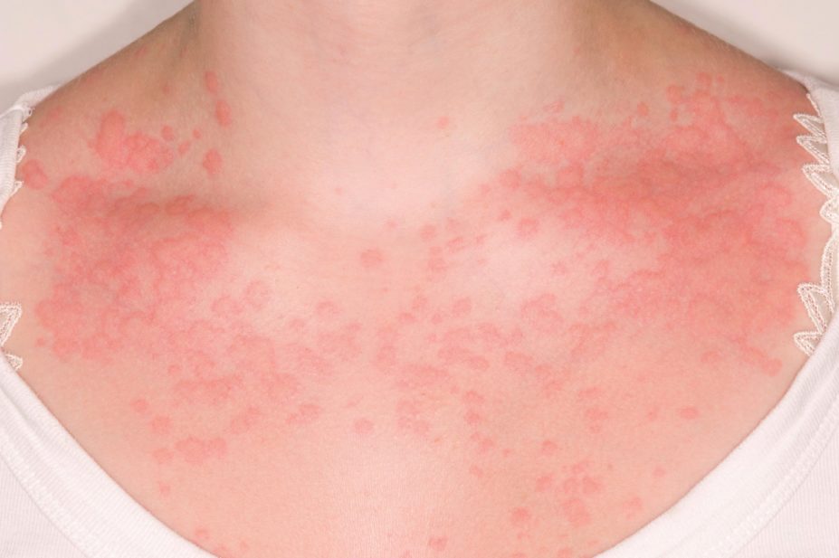 Urticaria rash on the upper chest of a woman