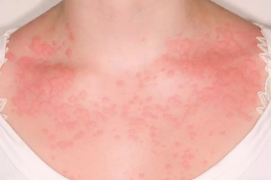 Itchy Rash On Arms Neck And Chest at Timothy Woodard blog