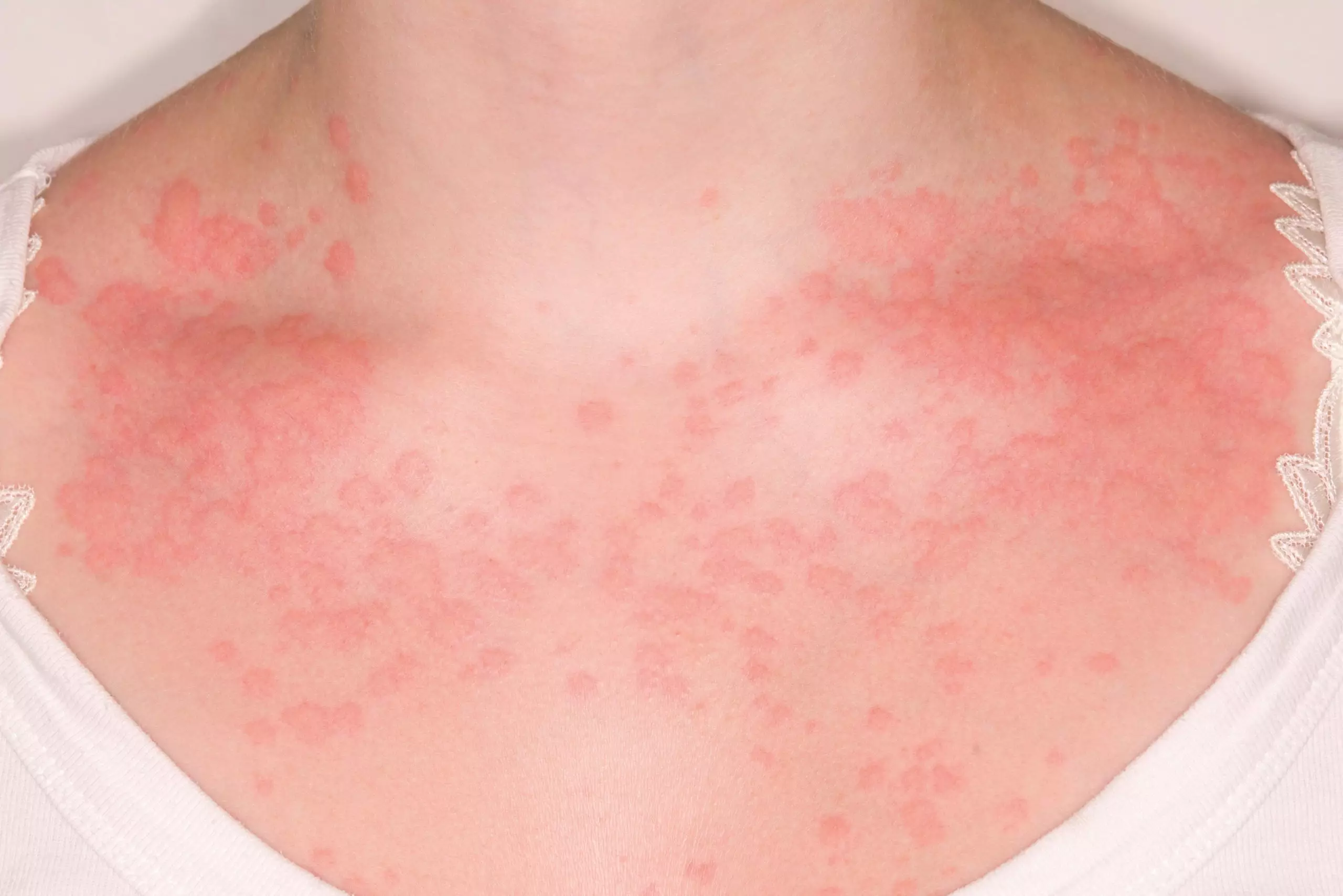 Urticaria Rash Upper Chest Female 16 Scaled 