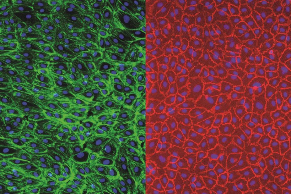Researchers develop test that predicts severe immune reaction to biologic therapies. Vascular lining cells (endothelium) grown from stem cells in human blood, visualised using two different stains (pictured).