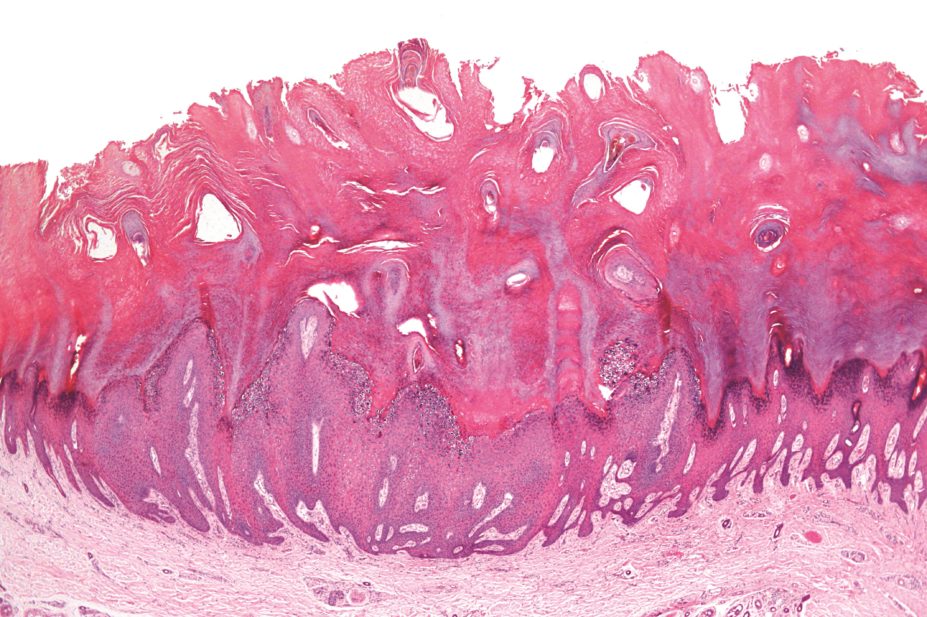 wart verruca virus intraductal papillary mucinous neoplasm