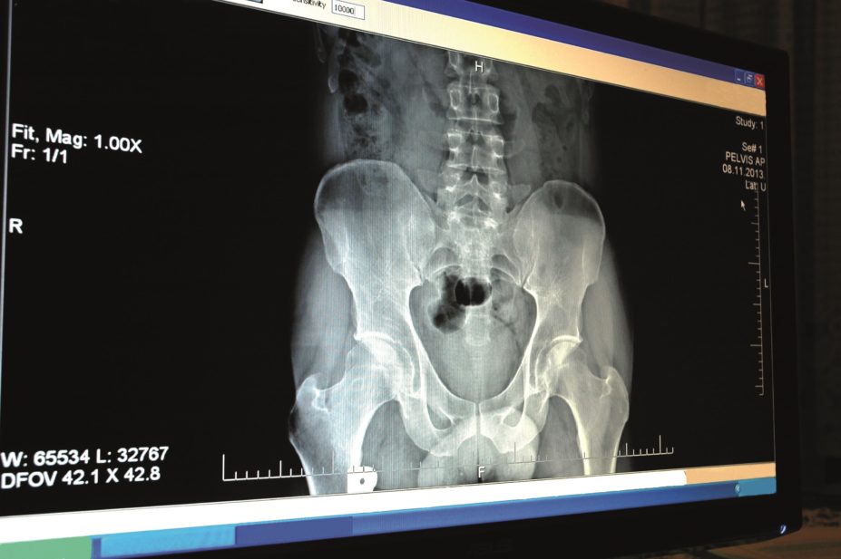 The rising numbers of people taking up the recommendations of calcium and vitamin D supplements to prevent and treat osteoporosis may be doing themselves more harm than good, says recent analysis. In the image, a hip x-ray on a computer