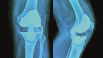 Patients with psoriasis who experience trauma to the joints or bones are up to 50% more likely to go on to develop psoriatic arthritis, a study finds. In the image, x-ray of the knee joints