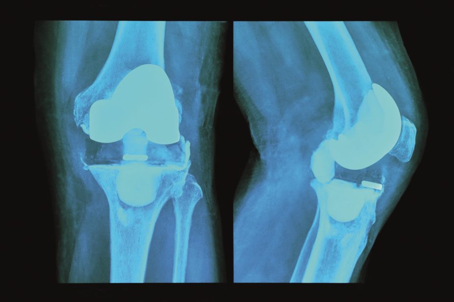 Patients with psoriasis who experience trauma to the joints or bones are up to 50% more likely to go on to develop psoriatic arthritis, a study finds. In the image, x-ray of the knee joints