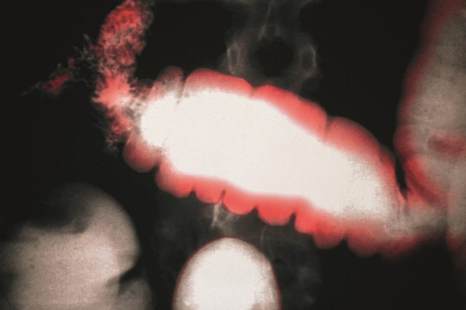 X-ray of the intestine showing cancer of the colon