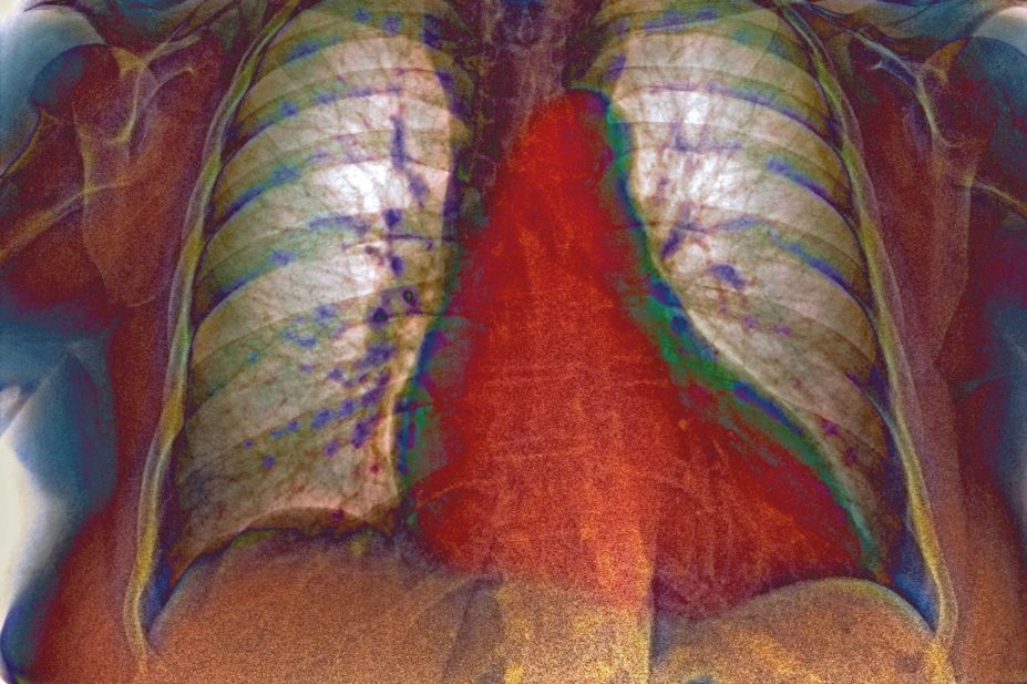 Coloured x-ray showing an enlarged heart