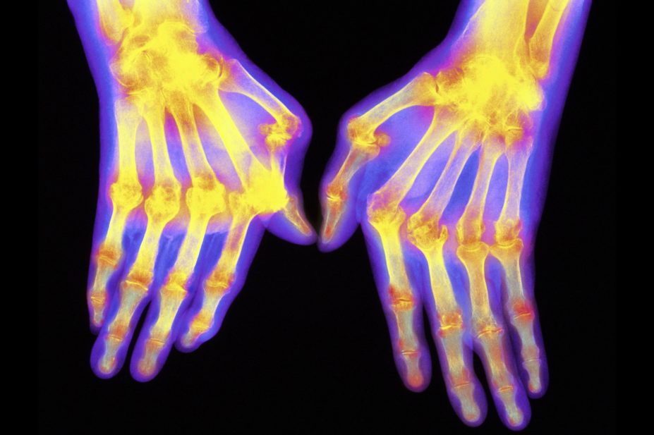 X-ray of arthritic hands