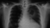 X-ray lung cancer