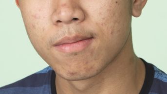 A new study tries to find out how vitamin B12 may be linked to acne. Taking vitamin B12 supplements affects the genes expressed by bacteria living on our skin. In the image, close-up of a teenage boy with acne
