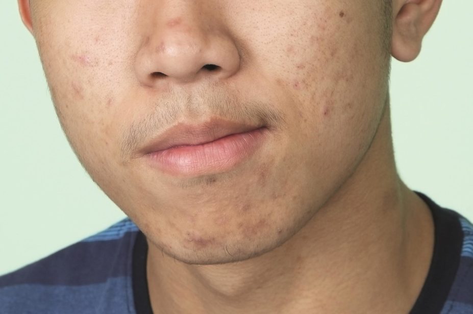 A new study tries to find out how vitamin B12 may be linked to acne. Taking vitamin B12 supplements affects the genes expressed by bacteria living on our skin. In the image, close-up of a teenage boy with acne