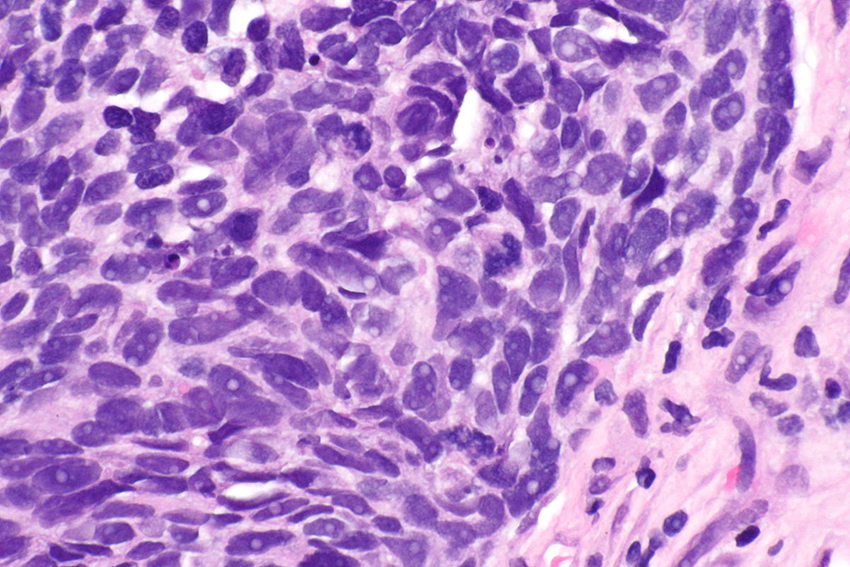 Non-small cell lung carcinoma NSCLC