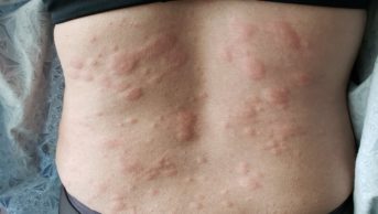 Person with urticaria on back