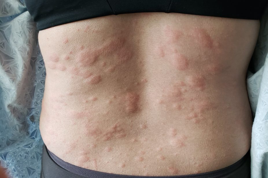 Person with urticaria on back