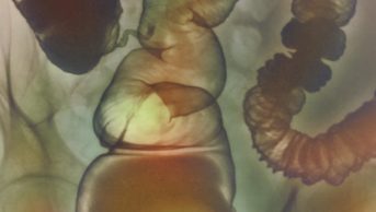 Researchers say that H1 antihistamines could therefore be explored as a new treatment approach in irritable bowel syndrome (IBS), x-ray pictured