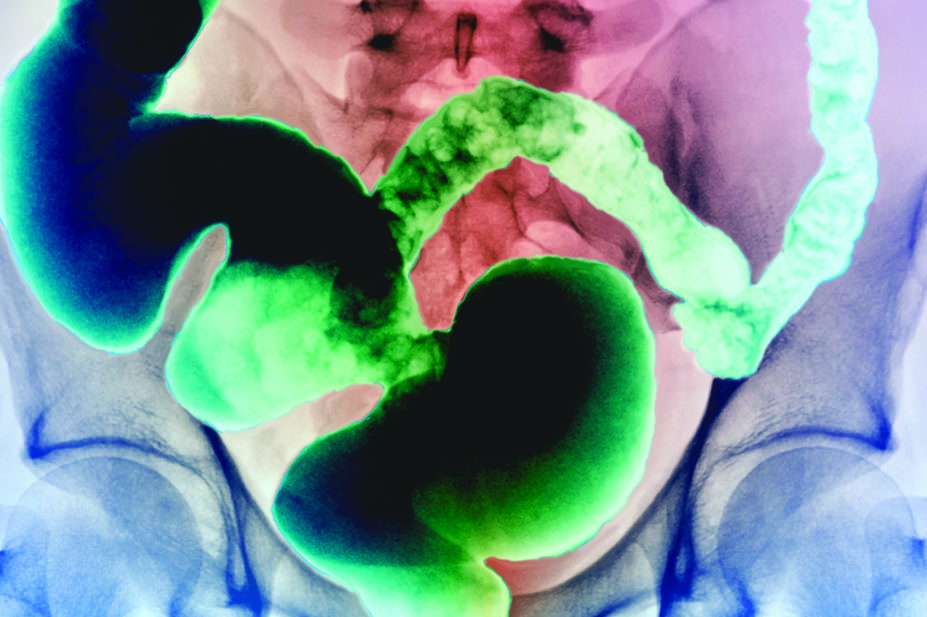 Xray showing inflammatory bowel disease
