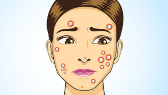 Do long-term antibiotics for acne fuel antimicrobial resistance?