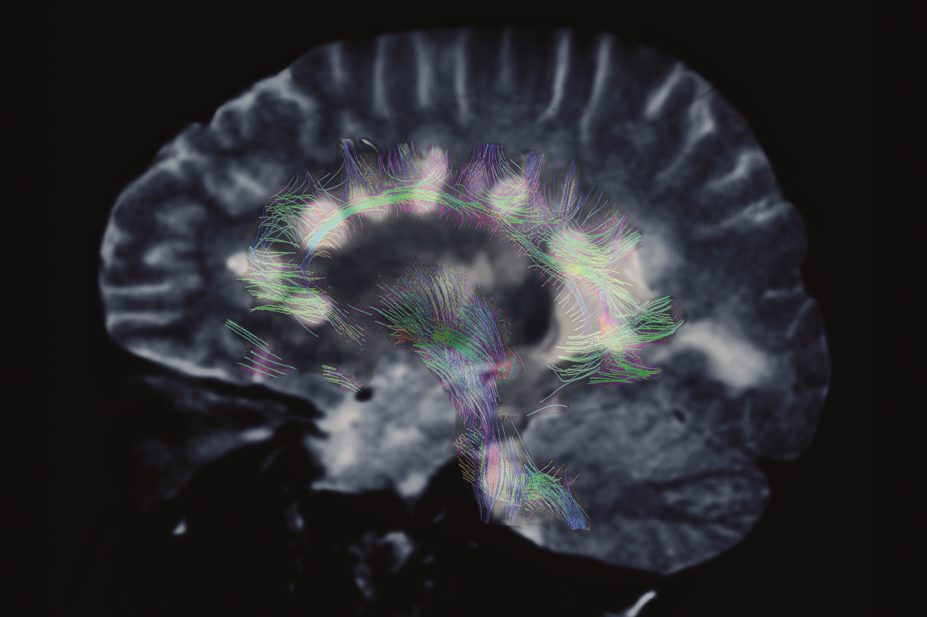 Coloured magnetic resonance imaging (MRI) scan of the brain, in profile, of a 35 year old woman with multiple sclerosis (MS)