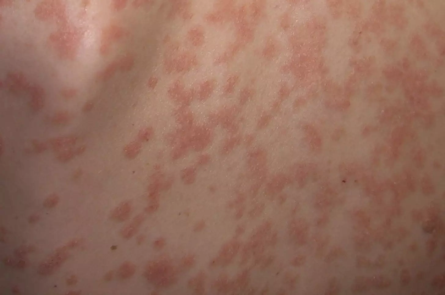 Tildrakizumab shows promise as psoriasis treatment - The Pharmaceutical ...