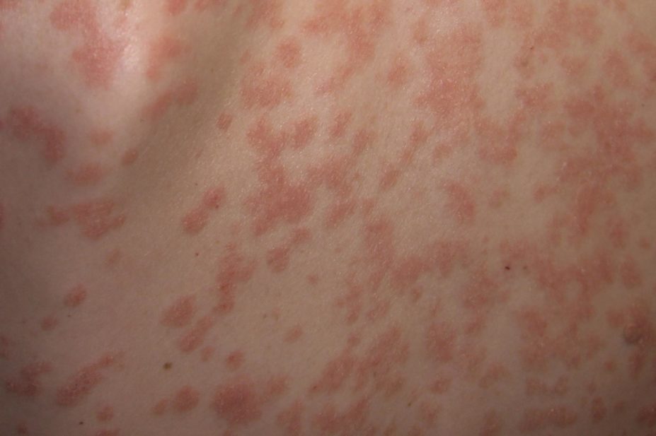 tekinumab, a monoclonal antibody (mAb) that targets the interleukin IL-23, is effective against psoriasis (pictured)