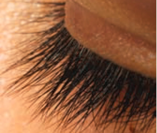 latanoprost-as-a-cosmetic-for-eyelashes-the-pharmaceutical-journal