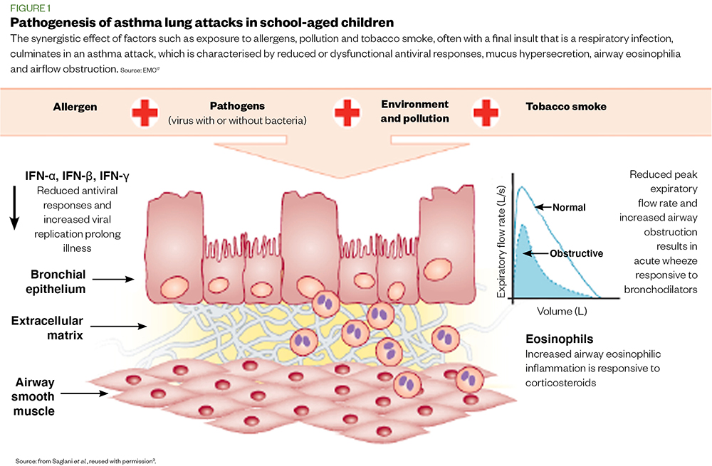 Figure 1 Pathogenesis of asthma lung attacks in school-aged children