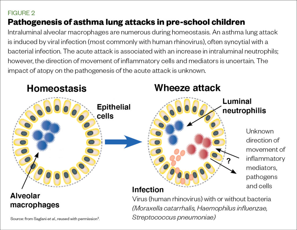Figure 2 Pathogenesis of asthma lung attacks in pre-school children