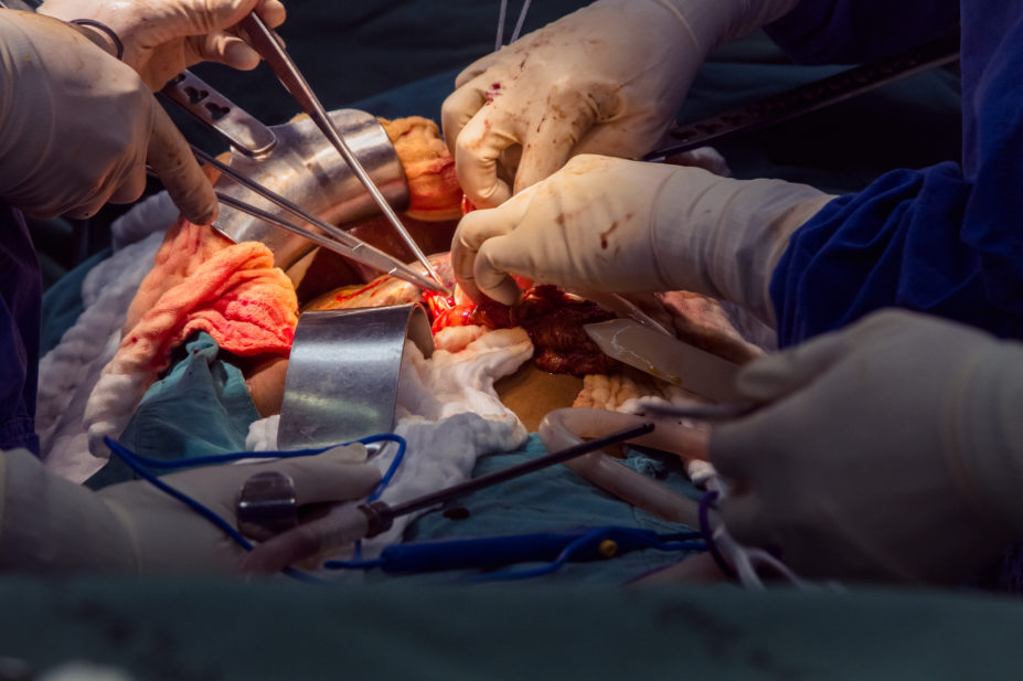 Patient undergoing liver transplant