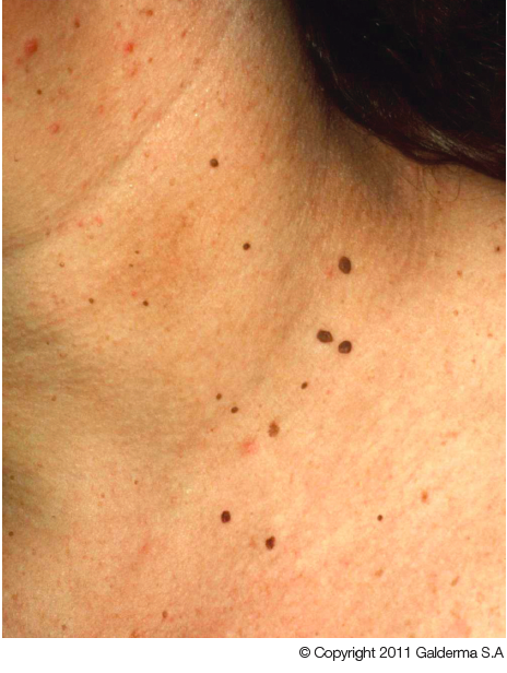 Warts on skin removal. Pin on naturiste