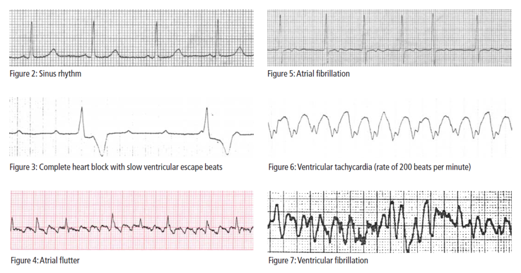 Arrhythmias Overview Of The Condition The Pharmaceutical Journal