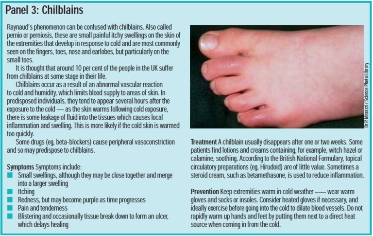 Managing Raynaud’s phenomenon - The Pharmaceutical Journal