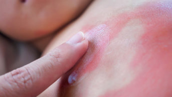 Doctor hand applying topical antihistamine medicine cream on little girl body with severe skin rash and allergy