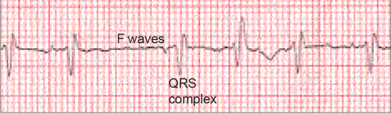 Arrhythmias: Part 2 - The Pharmaceutical Journal