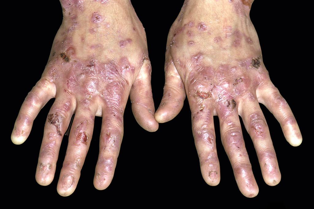 Figure 1: Epidermolysis bullosa skin blisters