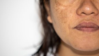 Woman's face showing Melasma