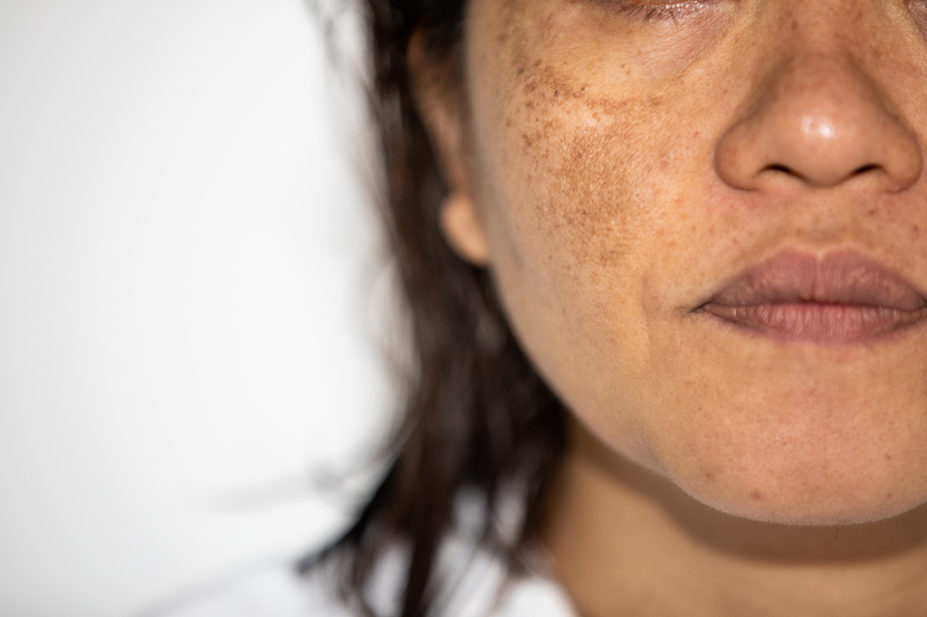 Woman's face showing Melasma