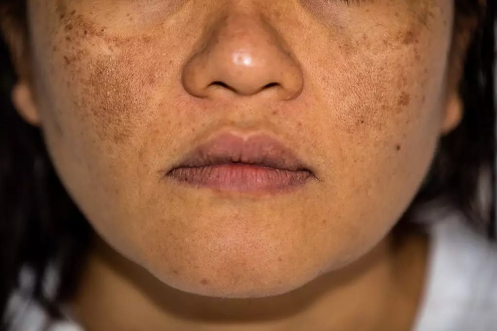 Figure 1: Melasma