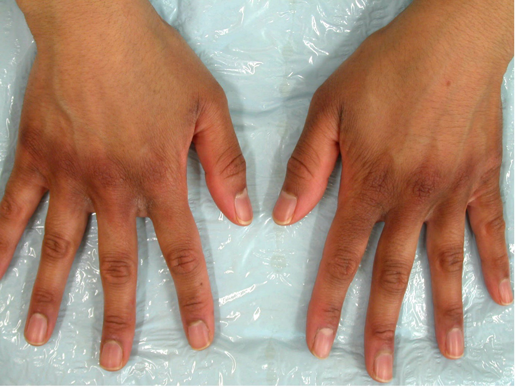 Figure 2: Post-inflammatory hyperpigmentation secondary to irritant contact dermatitis